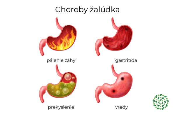 choroby zaludka-palenie zahy, gastritida, vredy, prekyslenie